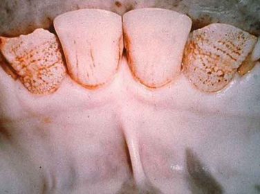 Flor Zehirlenmesi – Florosis