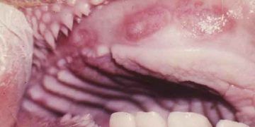 Bovine Papuller Stomatitis