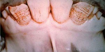 Flor Zehirlenmesi - Florosis