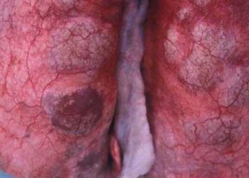 Keçilerde Verminöz Pneumoni (Paraziter Bronkopnömoni)