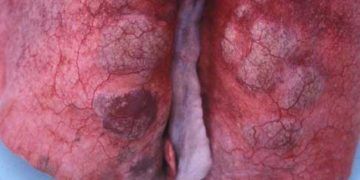 Keçilerde Verminöz Pneumoni (Paraziter Bronkopnömoni)