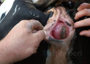 Bartolin Bezi Kisti Nedir?