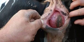 Bartolin Bezi Kisti Nedir?