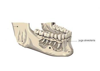 Yuga Alveolarya Nedir?