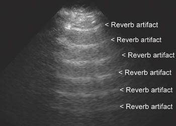 Yineleme Artefaktı Nedir?