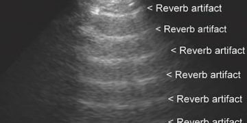 Yineleme Artefaktı Nedir?
