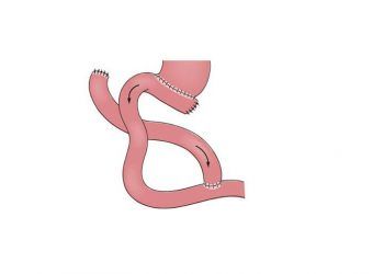 Yeyunoyeyenostomi Nedir?