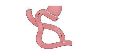 Yeyunoyeyenostomi Nedir?