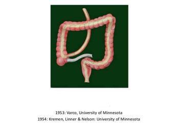 Yeyunuileustomi Nedir?