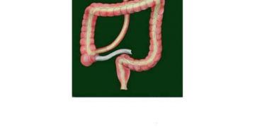 Yeyunuileustomi Nedir?