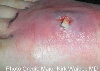 Yerel Enfeksiyon Nedir?