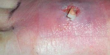 Yerel Enfeksiyon Nedir?