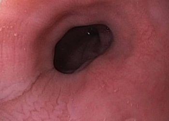 Yemek Borusu Yangısı Nedir?