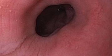 Yemek Borusu Yangısı Nedir?