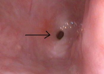 Yemek Borusu Daralması Nedir?
