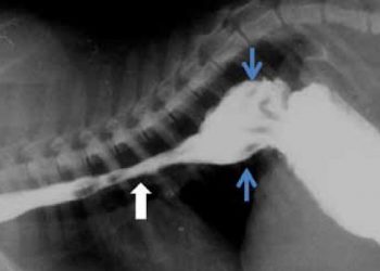 Yemek Borusu Divertikülümü Nedir?