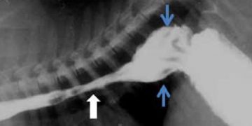 Yemek Borusu Divertikülümü Nedir?