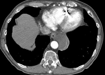 Yemek Borusu Duplikasyonu Nedir?
