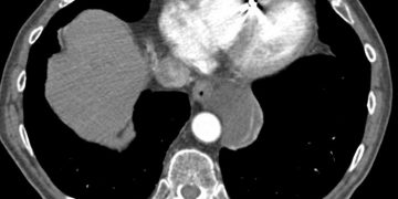 Yemek Borusu Duplikasyonu Nedir?