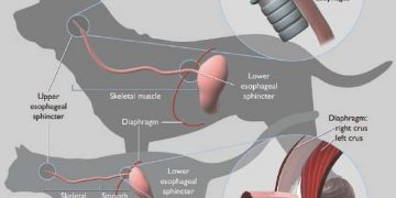 Yemek Borusu Ektazisi Nedir?