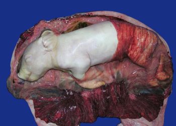 Yaygın Plasenta Nedir?