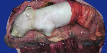 Yaygın Plasenta Nedir?