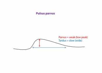 Yavaş Nabız Nedir?