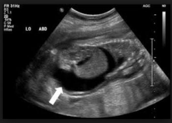 Yavru Zarları Hidropsu Nedir?