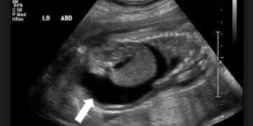 Yavru Zarları Hidropsu Nedir?