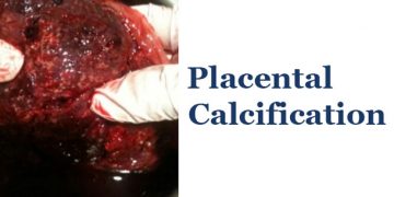 Yavru Zarları Kireçlenmesi Nedir?