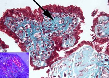 Yavru Zarlarında Metaplastik Kemikleşme Nedir?