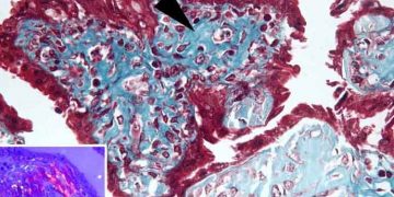 Yavru Zarlarında Metaplastik Kemikleşme Nedir?