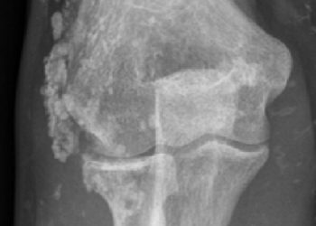 Yaygın Kalsinozis Nedir?