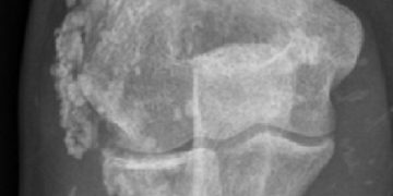 Yaygın Kalsinozis Nedir?