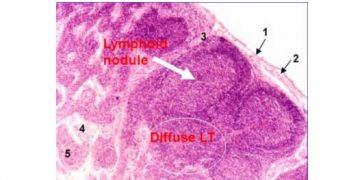Yaygın Lenfoid Doku Nedir?