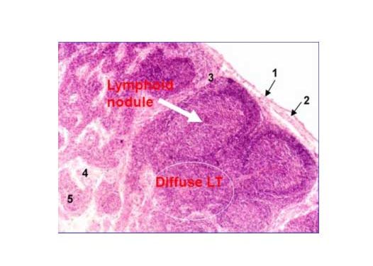 Yaygın Lenfoid Doku Nedir?