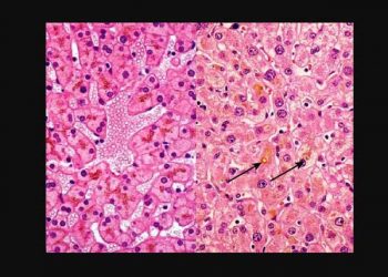 Yaşlanma Pigmenti Nedir?