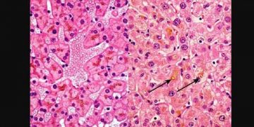 Yaşlanma Pigmenti Nedir?