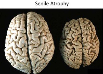 Yaşlılık Atrofisi Nedir?
