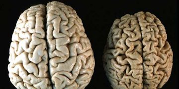 Yaşlılık Atrofisi Nedir?