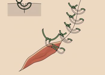 Yatay U Dikişi Nedir?