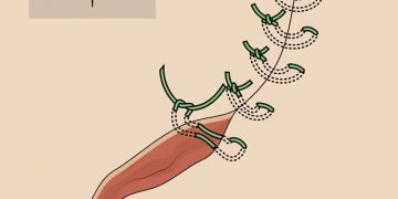 Yatay U Dikişi Nedir?