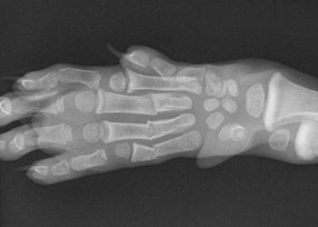 Yaş Ağaç Kırığı Nedir?