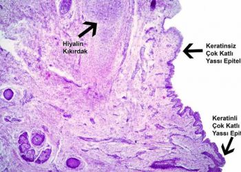Yassı Alveolar Hücre Nedir?