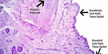 Yassı Alveolar Hücre Nedir?