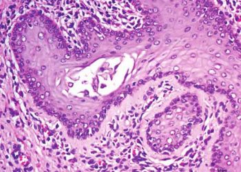 Yassı Hücreli Metaplazi Nedir?