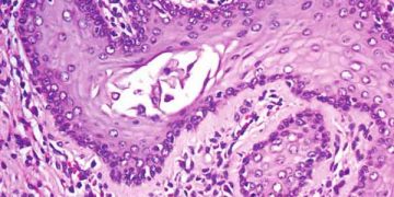 Yassı Hücreli Metaplazi Nedir?