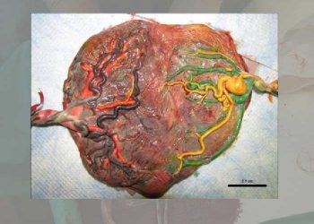 Yarım Plasenta Nedir?