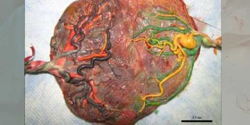 Yarım Plasenta Nedir?