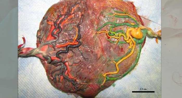Yarım Plasenta Nedir?